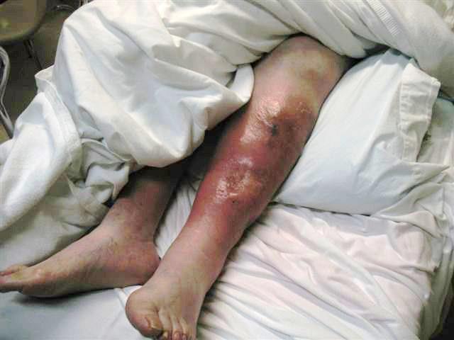 Peggy Marzolla, after suffering injuries in 2010. (Photo: Maureen Persi)